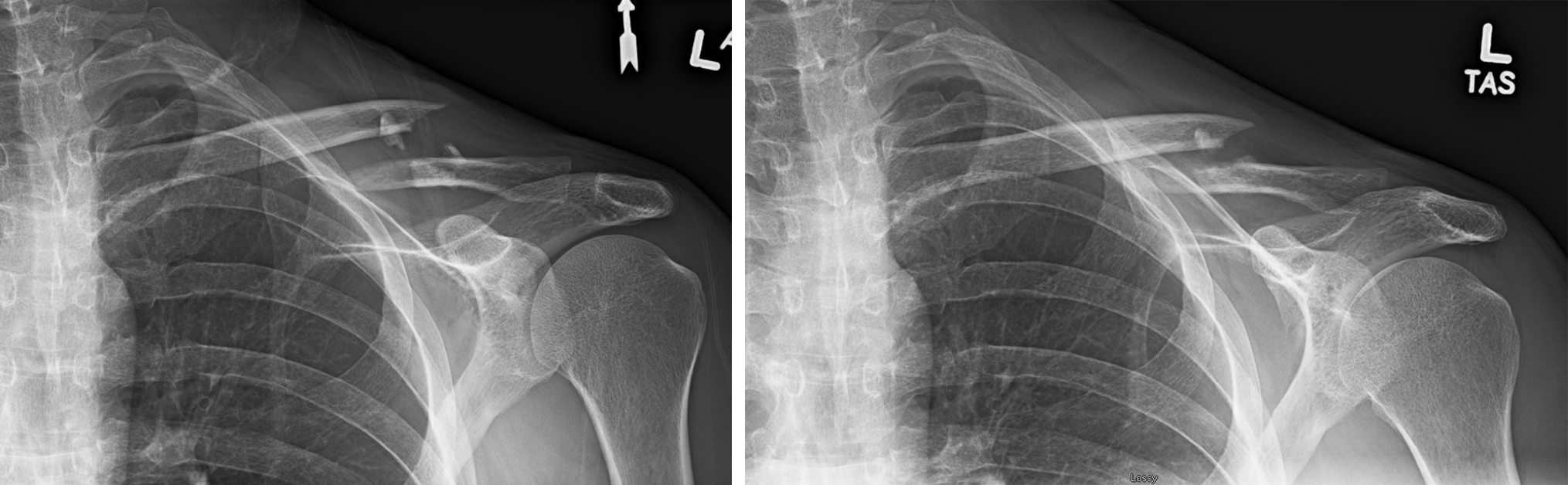 Patient Education - Clavicle Fractures (Broken Collarbone) TEST