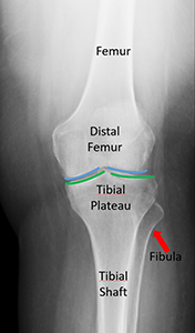 Distal Femur Fracture | Orthopaedic Trauma Association (OTA)