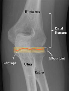 X-ray of an elbow showing the bones in the elbow, as well as the cartilage at the end of the humerus bone