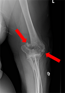 X-ray of a distal humerus fracture that is above the elbow joint and does not go through the cartilage