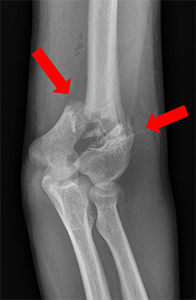 X-ray of a distal humerus fracture that goes through the cartilage and into the elbow joint