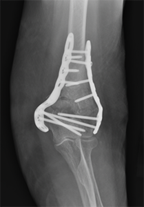 X-ray of a distal humerus fracture treated with metal plates and screws