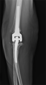 X-ray of a distal humerus fracture in an elderly patient treated with an elbow replacement