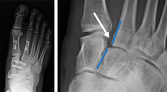 lisfranc ligament tear