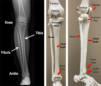 types of fibular fractures