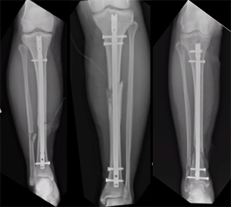 Tibia and fibula, shaft