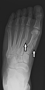 Fractures of the 1st and 2nd metatarsals