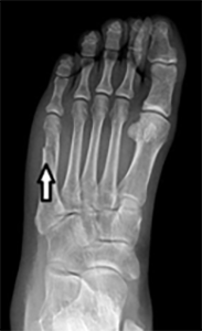 Fracture of the 5th metatarsal