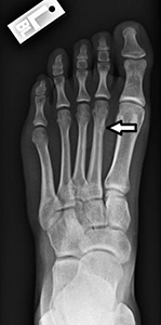 Stress fracture of the 2nd metatarsal