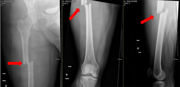 Front x-rays and side x-ray of a femur showing a fracture of the femoral shaft