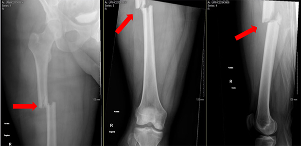 x rays of broken femur