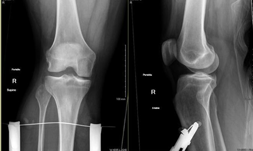 Front x-ray and side x-ray of a traction pin placed just below the knee