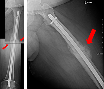 Front x-ray and side x-ray of a left femur taken about 3 months after fixation with an intramedullary nail