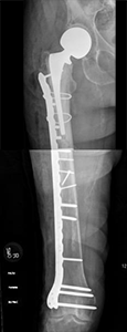 X-rays of a right femur fracture below a partial hip replacement