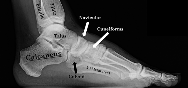 Image of the anatomy of the foot with the calcaneus or heel bone - calcaneal fracture