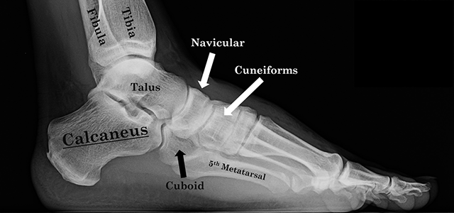 X-Ray pokazujący normalną kość piętową lub piętową