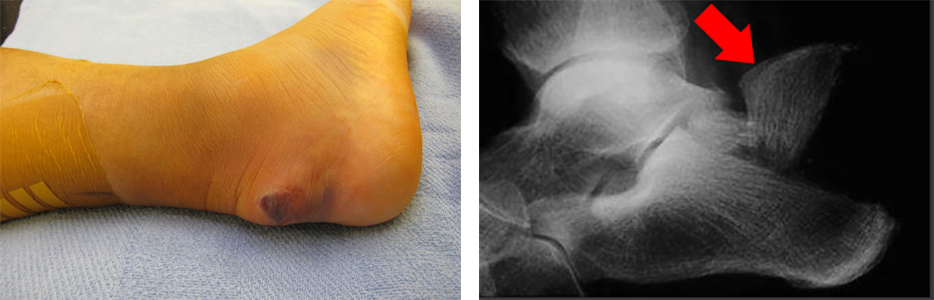 calcaneus fracture