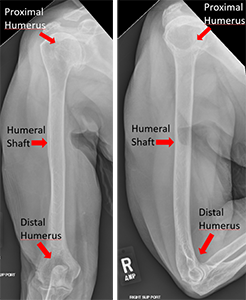 X Ray Shows Fracture Of The Humeral Head And Intrarotation Of The Arm ...