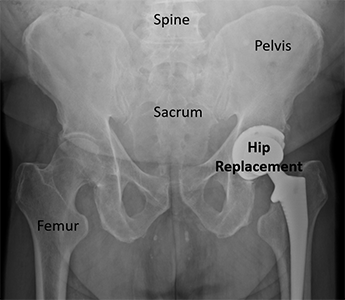 Periprosthetic Hip Fracture | Orthopaedic Trauma Association (OTA)