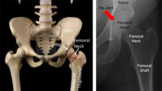 Young Patients with Femoral Neck Fracture | Orthopaedic Trauma