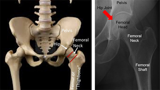 left femoral neck fracture