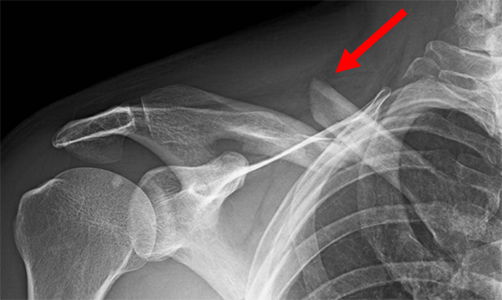 Fracture in the middle portion of the clavicle