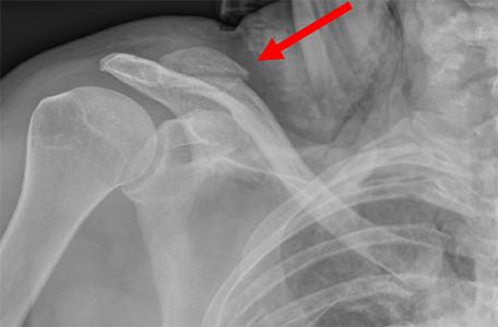 Fracture at the far end of the clavicle