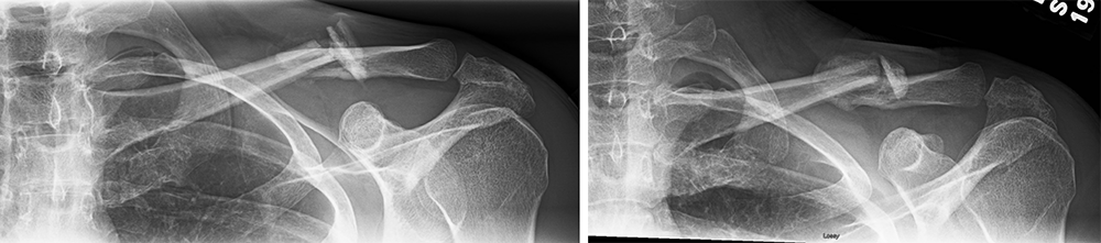 X-rays of a clavicle fracture