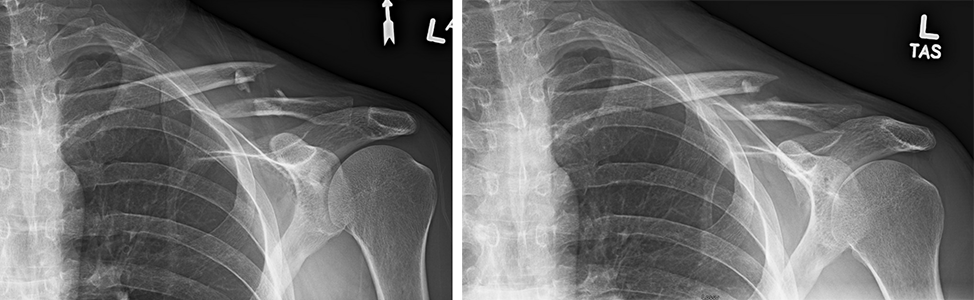X-rays of a patient with a clavicle fracture initially and 6 months later