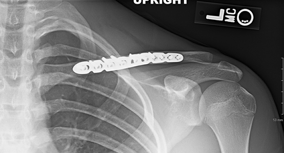A clavicle fracture after it has been fixed with a plate and screws