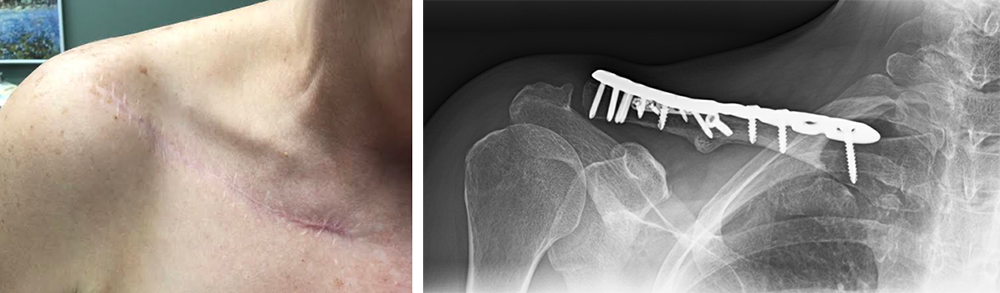 A scar and some prominence of the plate after a clavicle was fixed with surgery