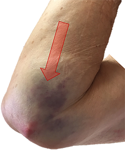 Photograph of an elbow fracture dislocation, showing the amount of swelling and bruising that is seen after this injury