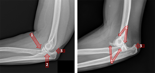 X-rays of elbow fracture dislocations.