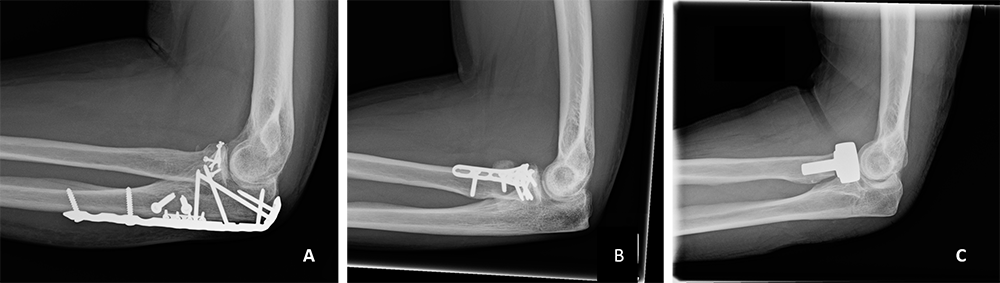 X-ray of elbow fracture dislocations after surgery