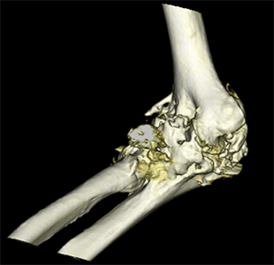 &quot;CAT- scan&quot; of an elbow fracture dislocation that formed heterotopic ossification (extra bone)