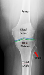 X-ray showing the location of the distal femur and a normal knee joint