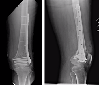 X-rays of a patient with a distal femur fracture treated with plates and screws