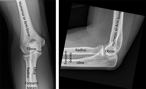 X-rays of a normal elbow showing the elbow joint and the bones that form the joint