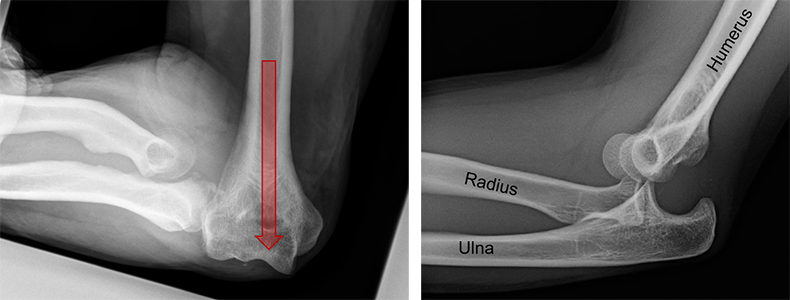 X-rays of an elbow dislocation