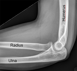 X-rays after reduction of the same elbow, now back to normal