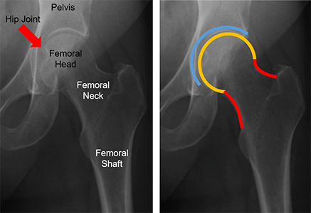 The image on the left is an x-ray of an adult hip, on the right the femoral neck