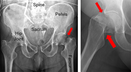 X-rays of a displaced femoral neck fracture