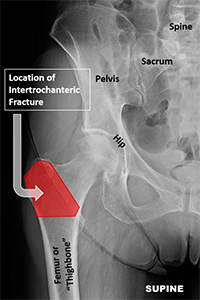Normal x-ray showing the femur, or thigh bone, and how it contributes to the hip joint