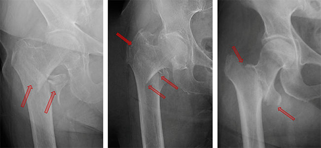 X-rays showing three different examples of intertrochanteric fractures
