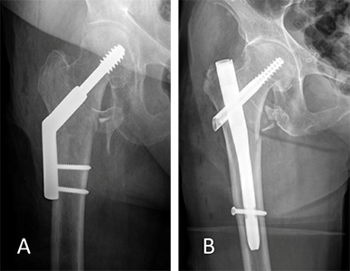 X-rays showing two different intertrochanteric fractures after surgery