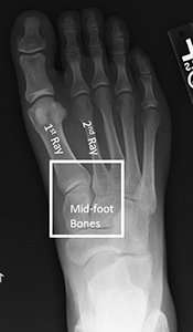 X-ray of the top of a foot