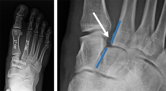 X-ray of a LisFranc injury