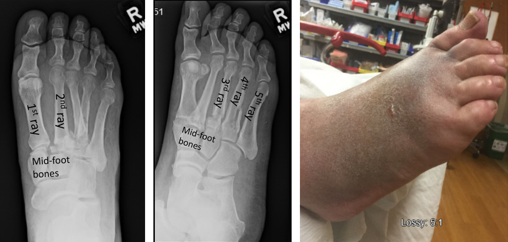This patient had a crush injury to his foot, part 1