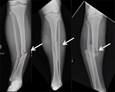 Examples of tibia fractures