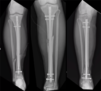 Examples of tibia fractures treated with a rod/nail and screws